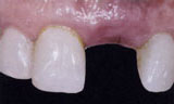 Tooth implant