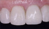 Tooth implant