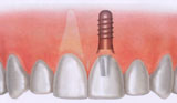 Tooth implant