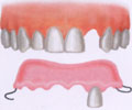Traditional Removable Partial Denture