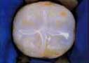 Molar sealant on teeth