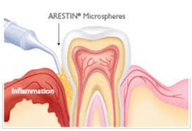 gum disease treatment graphic