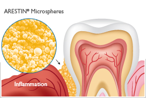 gum disease treatment graphic