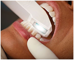 Digital impressions of teeth