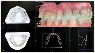 Digital impressions of teeth