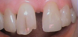 Enamel reshaping before photo