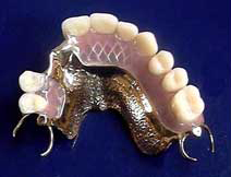 Partial dentures