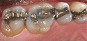Before Traditional Silver Fillings