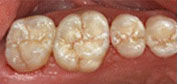 After Composite Resin Tooth Colored Fillings
