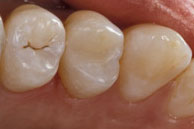 After Composite Resin Tooth Colored Filling