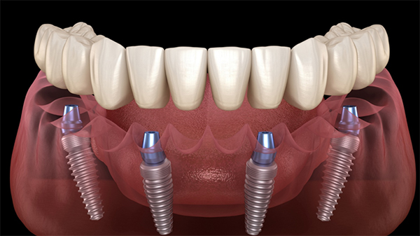 all-on-four dental implants