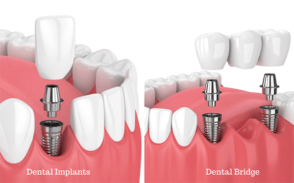 dental implants dental bridge