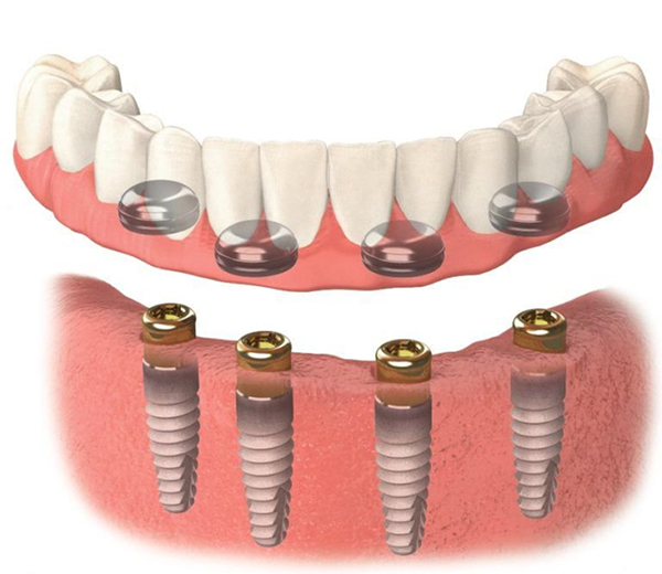 implant supported overdenture