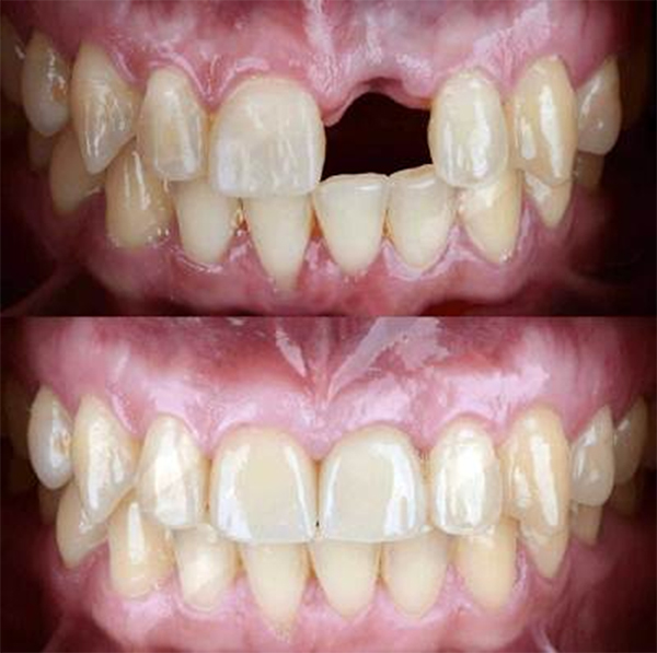 single tooth implant